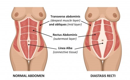 Os abdominais hipopressivos e a diástase